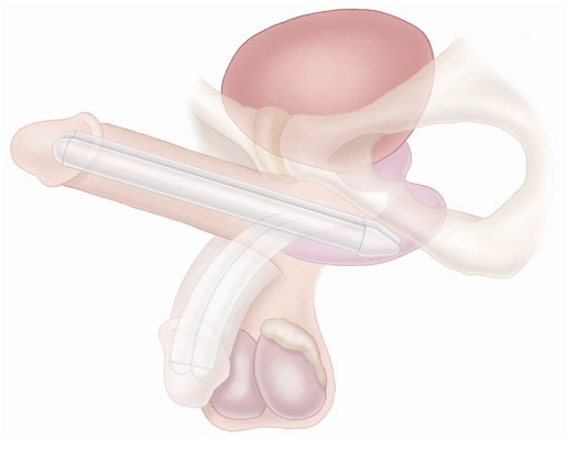 AMS Tactra™ Malleable Penile Implant.