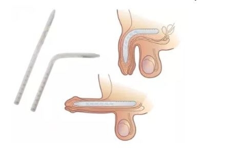 Genesis™ Flexible Rod Penile Implant