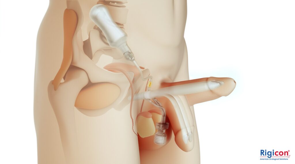 Infla10® Pulse™ Series – Dynamic Inflatable Penile Prosthesis (DIPP)