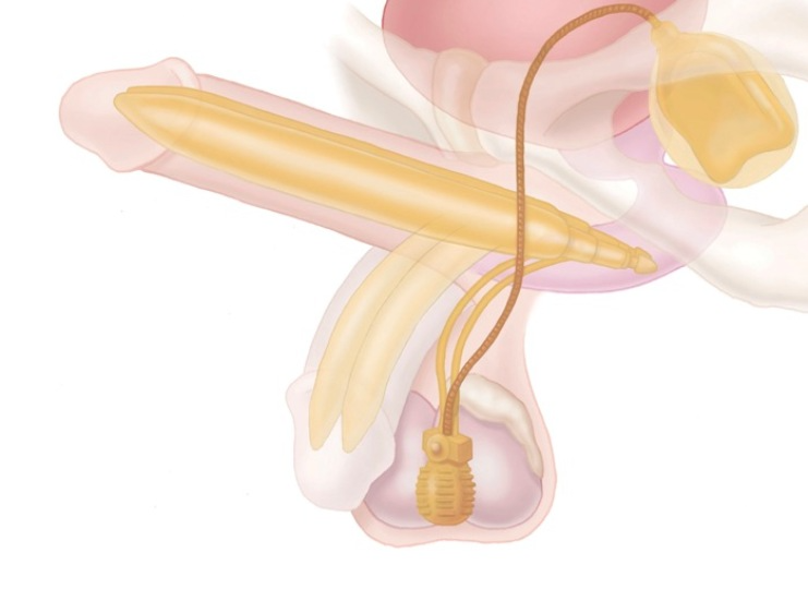 AMS 700™ Penile Implant