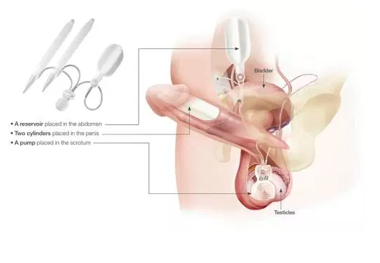 Coloplast® Titan® Touch penile implant.